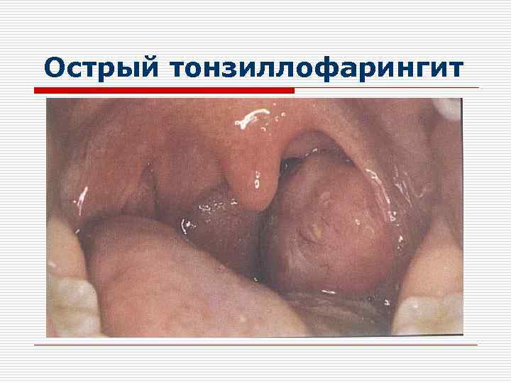 Острый тонзиллофарингит 