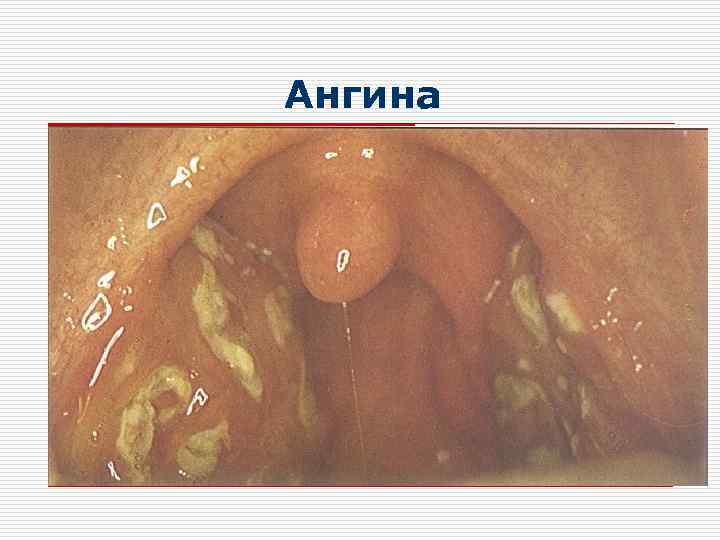 Ангина 