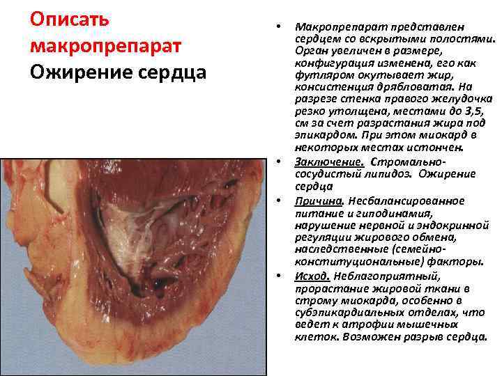 Описать  •  Макропрепарат представлен    сердцем со вскрытыми полостями. 