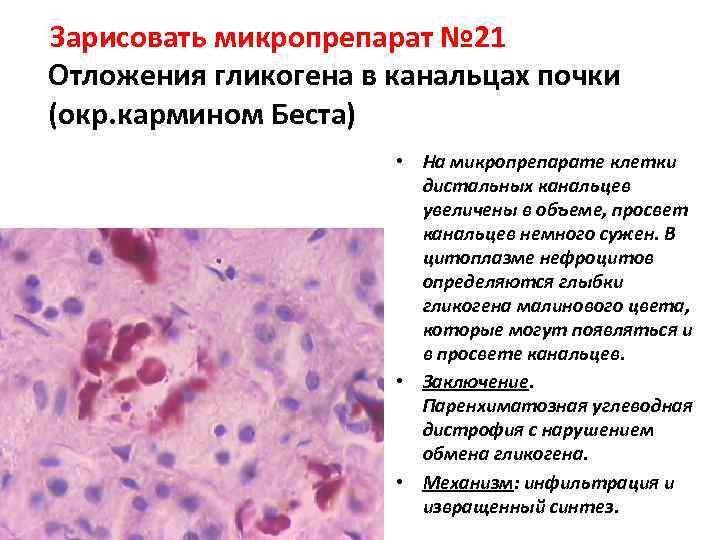 Зарисовать микропрепарат № 21 Отложения гликогена в канальцах почки (окр. кармином Беста)  