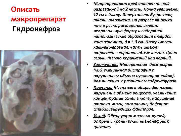    •  Макропрепарат представлен почкой Описать   разрезанной на 2