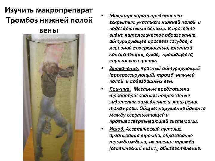 Изучить макропрепарат      •  Макропрепарат представлен  Тромбоз нижней
