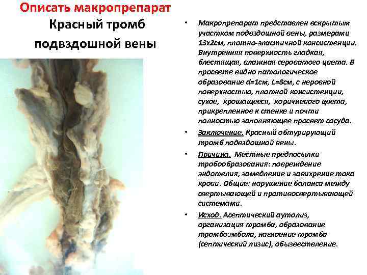 Описать макропрепарат Красный тромб  •  Макропрепарат представлен вскрытым    