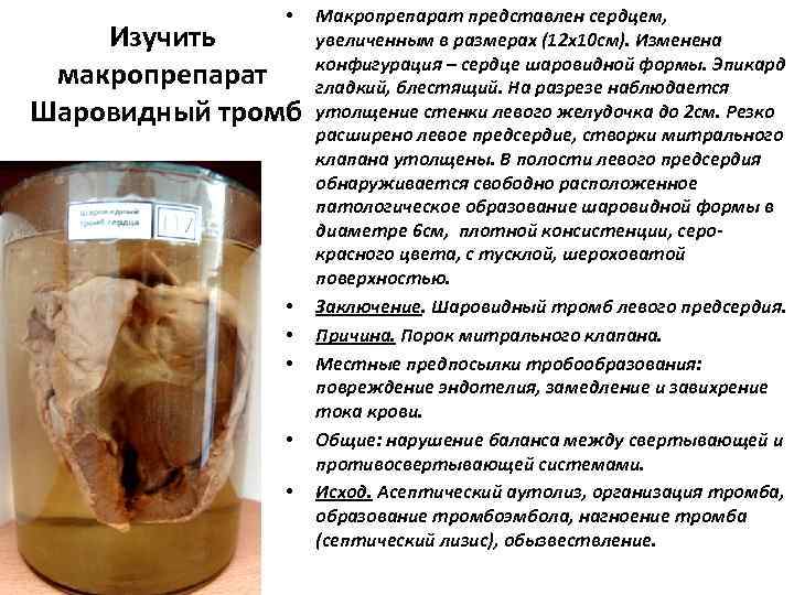    •  Макропрепарат представлен сердцем,  Изучить  увеличенным в размерах