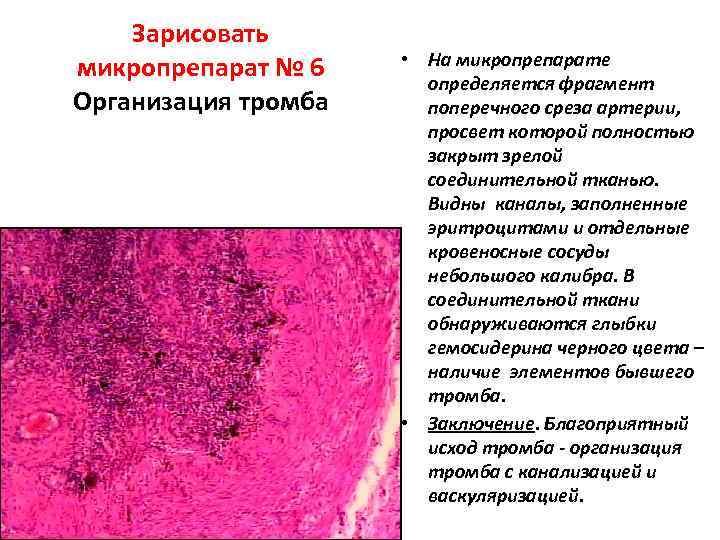 Хроническое венозное полнокровие печени микропрепарат рисунок