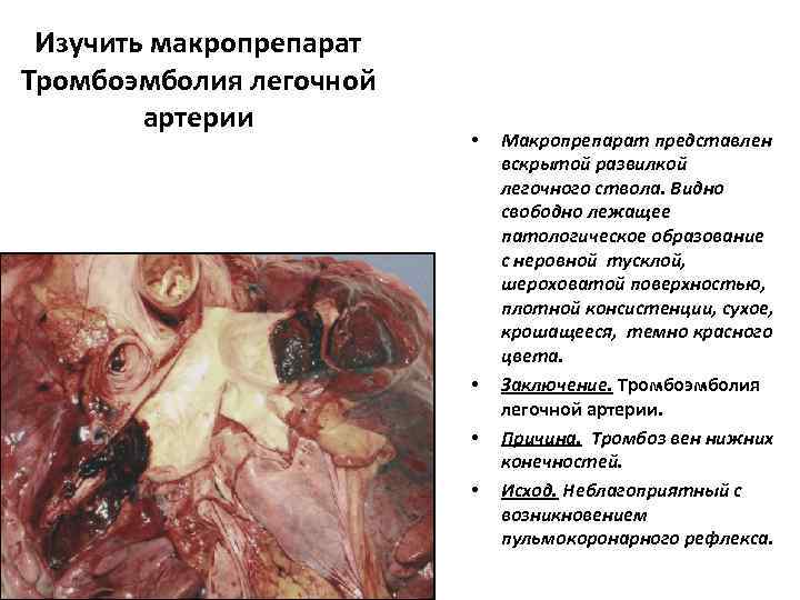  Изучить макропрепарат Тромбоэмболия легочной   артерии      •