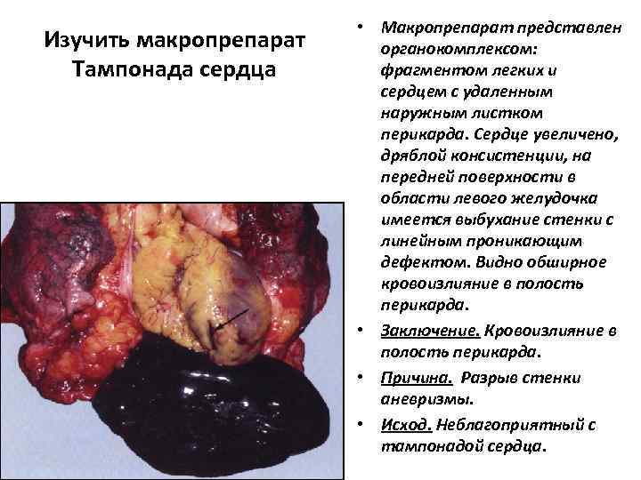      • Макропрепарат представлен Изучить макропрепарат органокомплексом: Тампонада сердца 
