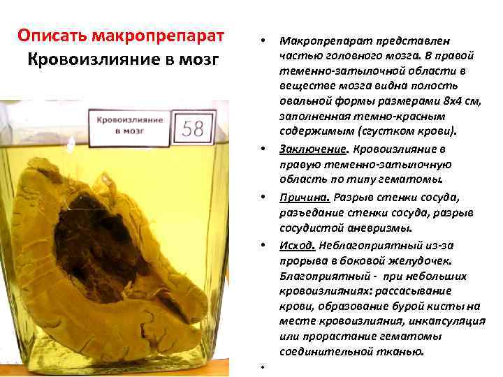 Описать макропрепарат  •  Макропрепарат представлен  Кровоизлияние в мозг  частью головного