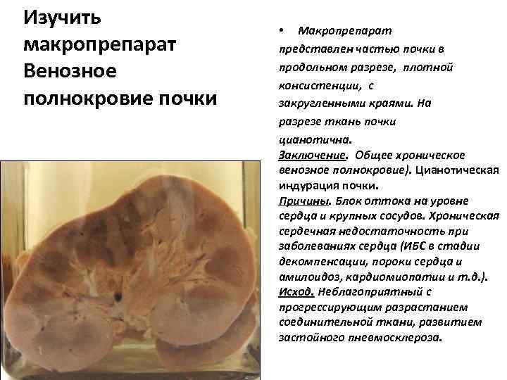 Изучить    • Макропрепарат макропрепарат  представлен частью почки в Венозное 