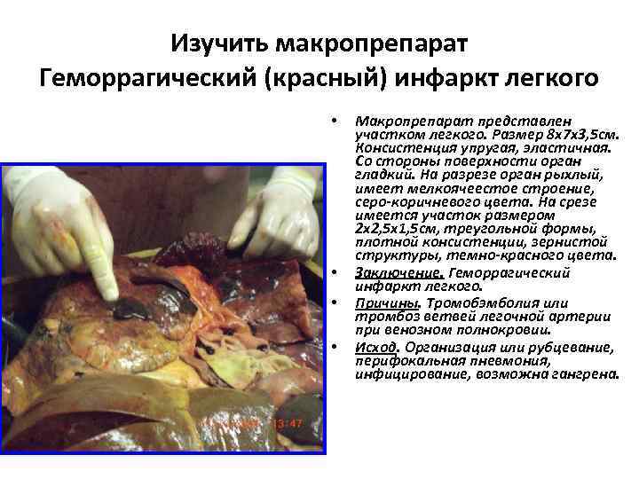    Изучить макропрепарат Геморрагический (красный) инфаркт легкого    • 
