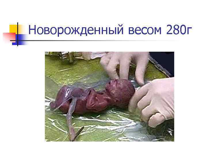 Новорожденный весом 280 г 