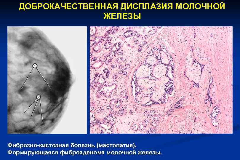   ДОБРОКАЧЕСТВЕННАЯ ДИСПЛАЗИЯ МОЛОЧНОЙ    ЖЕЛЕЗЫ Фиброзно-кистозная болезнь (мастопатия). Формирующаяся фиброаденома