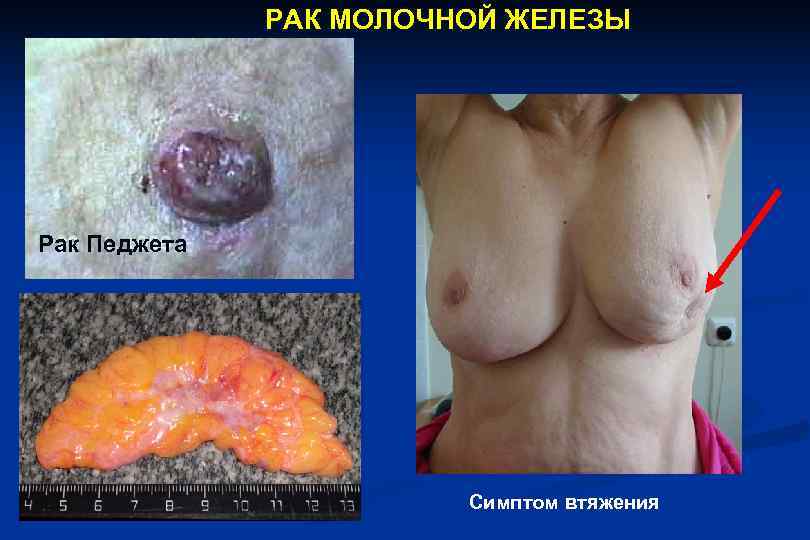    РАК МОЛОЧНОЙ ЖЕЛЕЗЫ Рак Педжета     Симптом втяжения