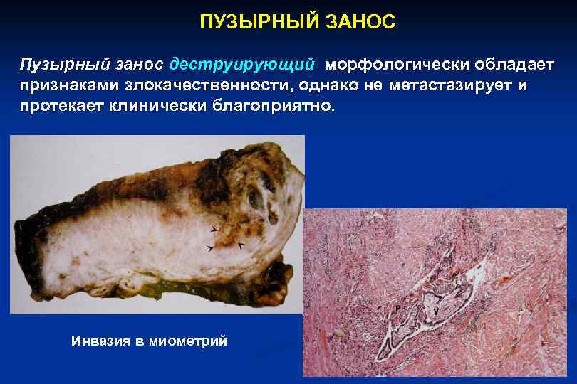     ПУЗЫРНЫЙ ЗАНОС Пузырный занос деструирующий морфологически обладает признаками злокачественности, однако