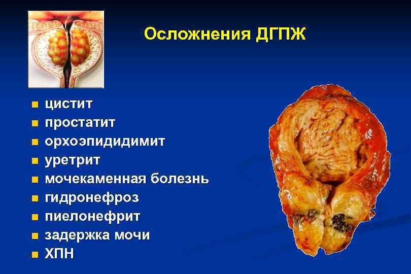     Осложнения ДГПЖ  n  цистит n  простатит n