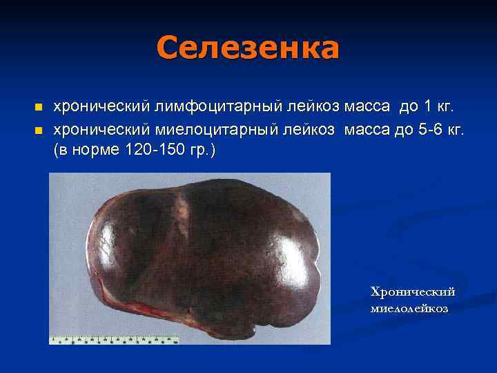     Селезенка n  хронический лимфоцитарный лейкоз масса до 1 кг.