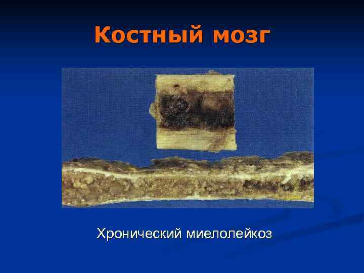 Костный мозг Хронический миелолейкоз 