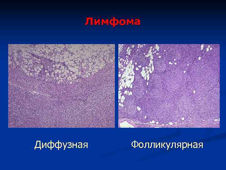   Лимфома Диффузная  Фолликулярная 