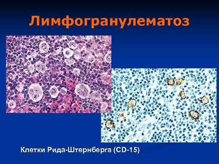  Лимфогранулематоз Клетки Рида-Штернберга (СD-15) 