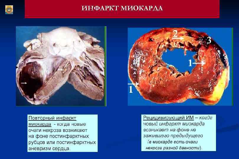 ИНФАРКТ МИОКАРДА 