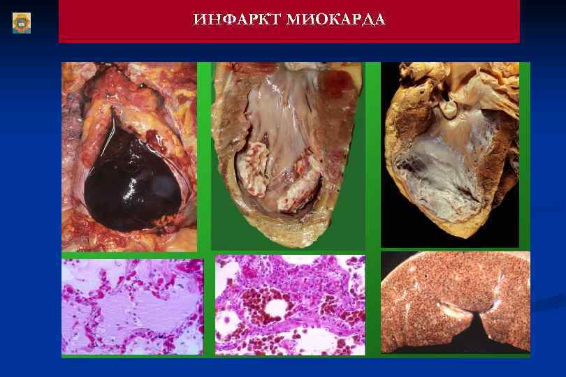 ИНФАРКТ МИОКАРДА 