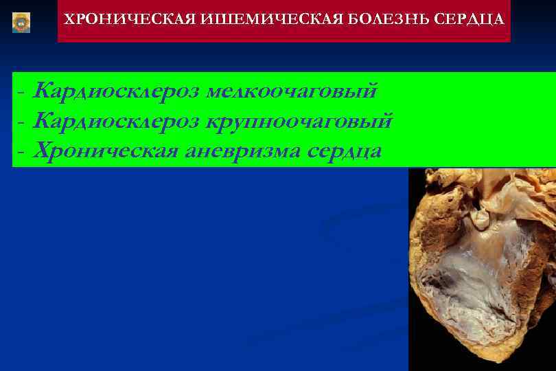   ХРОНИЧЕСКАЯ ИШЕМИЧЕСКАЯ БОЛЕЗНЬ СЕРДЦА  - Кардиосклероз мелкоочаговый - Кардиосклероз крупноочаговый -