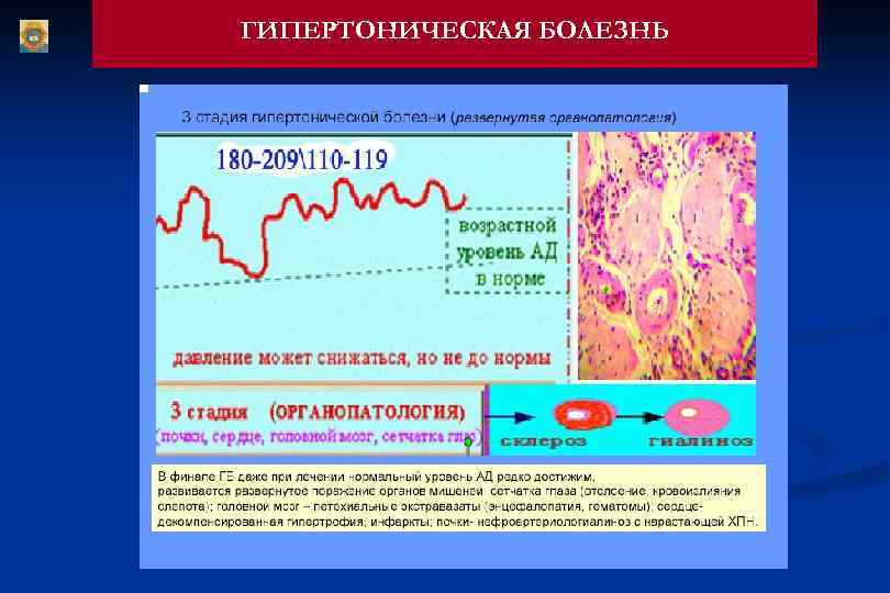 ГИПЕРТОНИЧЕСКАЯ БОЛЕЗНЬ 