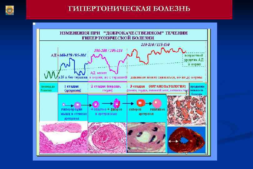 ГИПЕРТОНИЧЕСКАЯ БОЛЕЗНЬ 