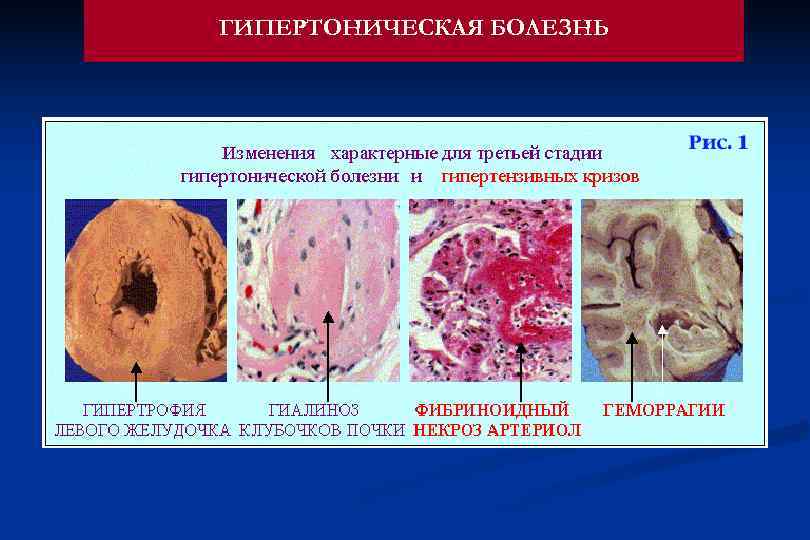 ГИПЕРТОНИЧЕСКАЯ БОЛЕЗНЬ 