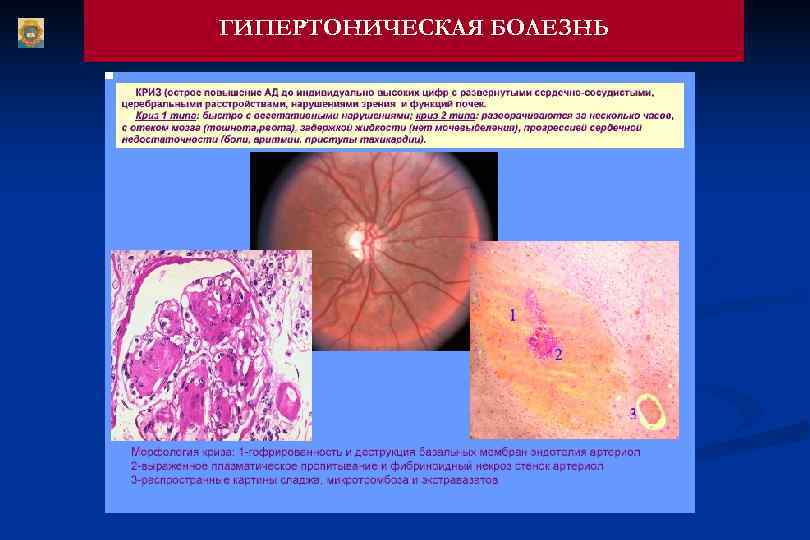 ГИПЕРТОНИЧЕСКАЯ БОЛЕЗНЬ 