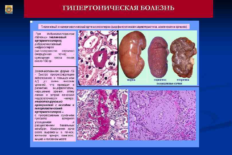 ГИПЕРТОНИЧЕСКАЯ БОЛЕЗНЬ 