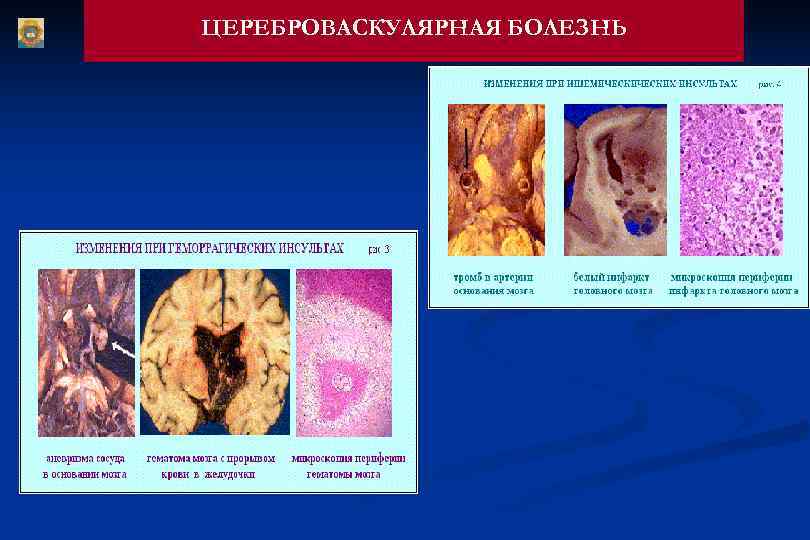 ЦЕРЕБРОВАСКУЛЯРНАЯ БОЛЕЗНЬ 