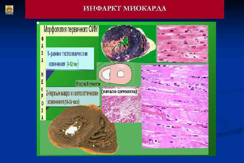 ИНФАРКТ МИОКАРДА 
