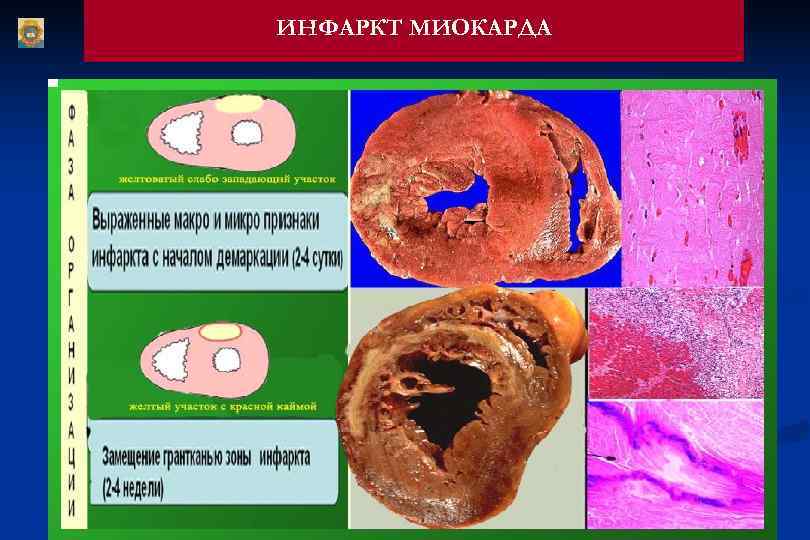 ИНФАРКТ МИОКАРДА 