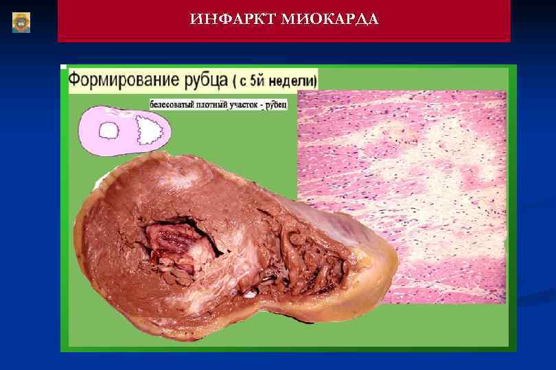 ИНФАРКТ МИОКАРДА 