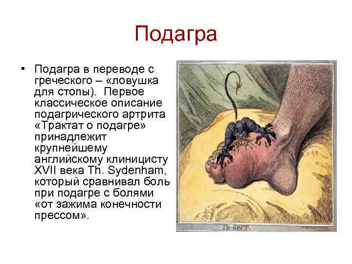     Подагра • Подагра в переводе с  греческого – «ловушка