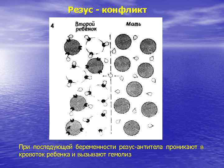 Резус - конфликт При последующей беременности резус-антитела проникают в кровоток ребенка Резус - конфликт При последующей беременности резус-антитела проникают в кровоток ребенка