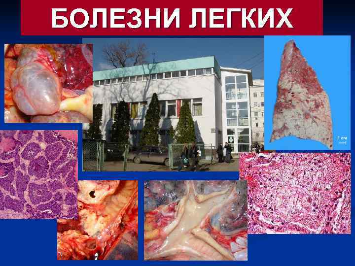 БОЛЕЗНИ ЛЕГКИХ 