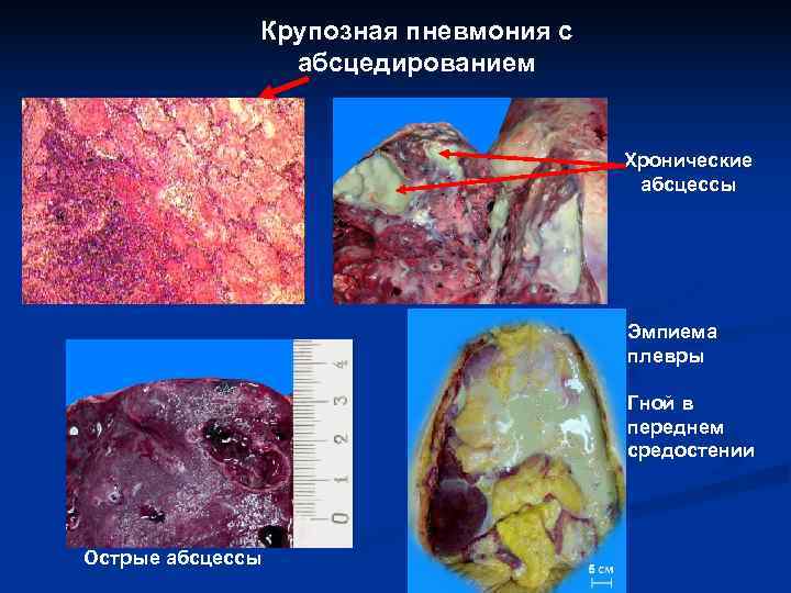    Крупозная пневмония с   абсцедированием     