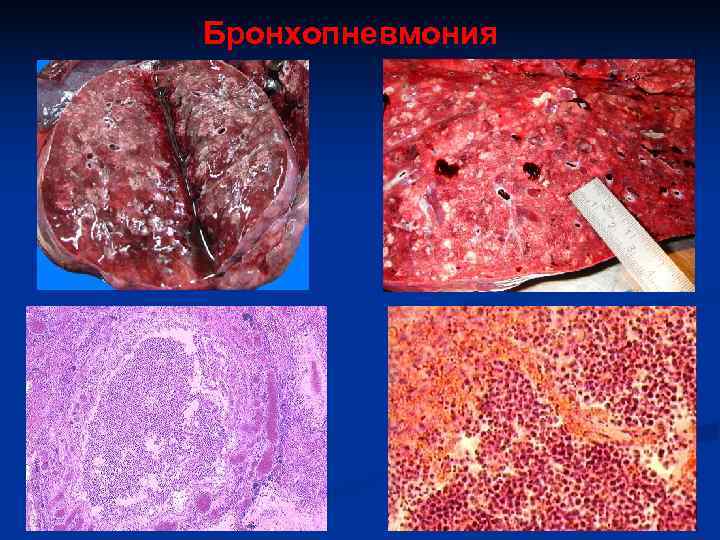 Бронхопневмония 