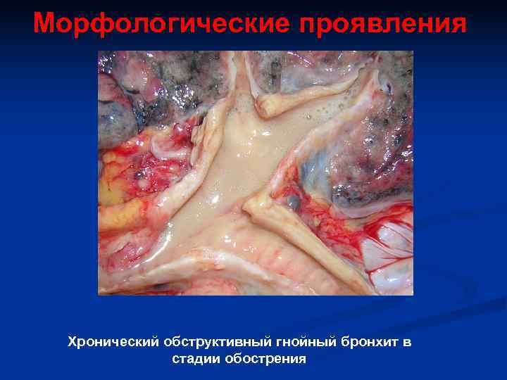 Морфологические проявления  Хронический обструктивный гнойный бронхит в   стадии обострения 