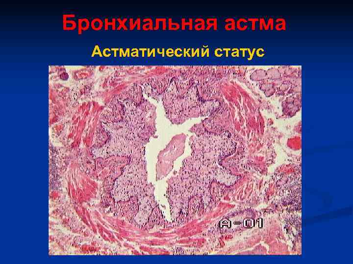 Бронхиальная астма  Астматический статус 