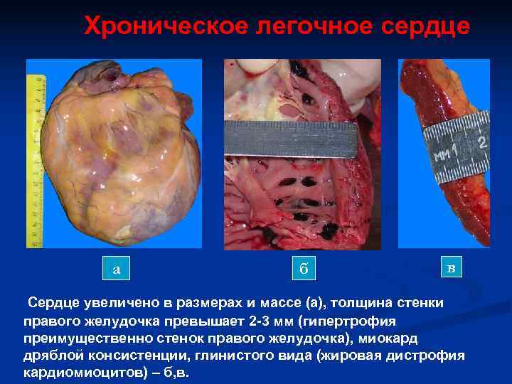   Хроническое легочное сердце    а    б 