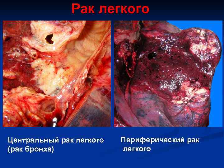     Рак легкого Центральный рак легкого  Периферический рак (рак бронха)