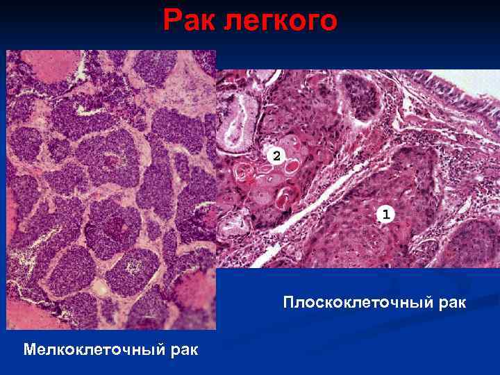    Рак легкого     Плоскоклеточный рак Мелкоклеточный рак 