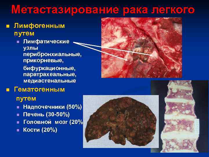   Метастазирование рака легкого n  Лимфогенным путем n  Лимфатические  