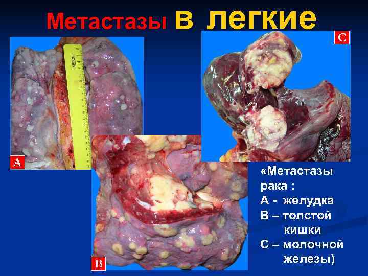   Метастазы в легкие      С А  