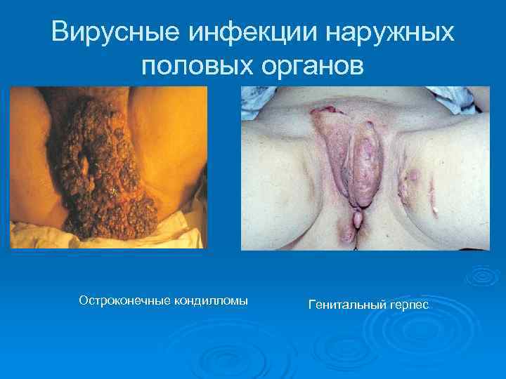 Вирусные инфекции наружных половых органов Остроконечные кондилломы Генитальный герпес Вирусные инфекции наружных половых органов Остроконечные кондилломы Генитальный герпес