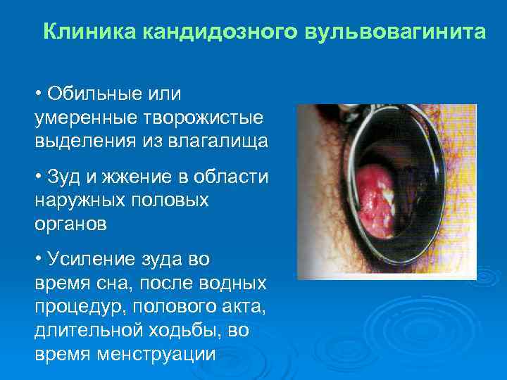 Клиника кандидозного вульвовагинита • Обильные или умеренные творожистые выделения из влагалища • Зуд Клиника кандидозного вульвовагинита • Обильные или умеренные творожистые выделения из влагалища • Зуд