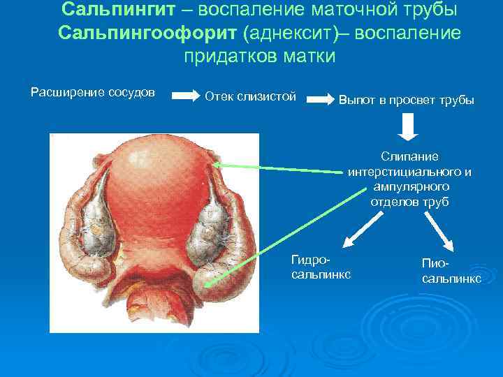 Сальпингит – воспаление маточной трубы Сальпингоофорит (аднексит)– воспаление Сальпингит – воспаление маточной трубы Сальпингоофорит (аднексит)– воспаление